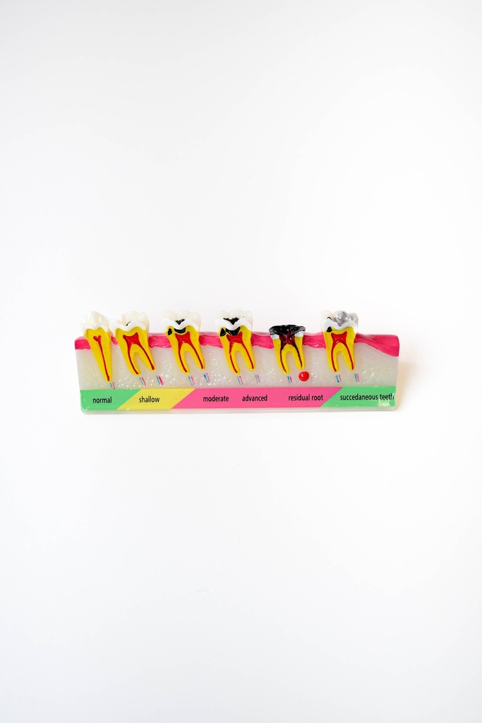 MODELO PROGRESIÓN DE CARIES