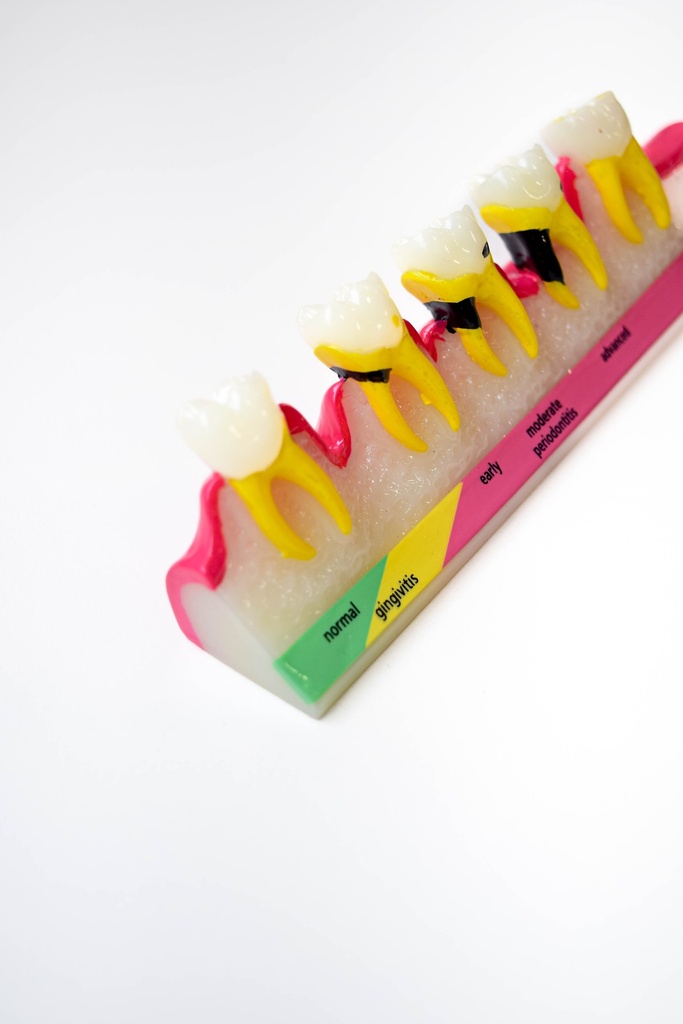 MODELO PROGRESIÓN DE ENFERMEDAD PERIODONTAL
