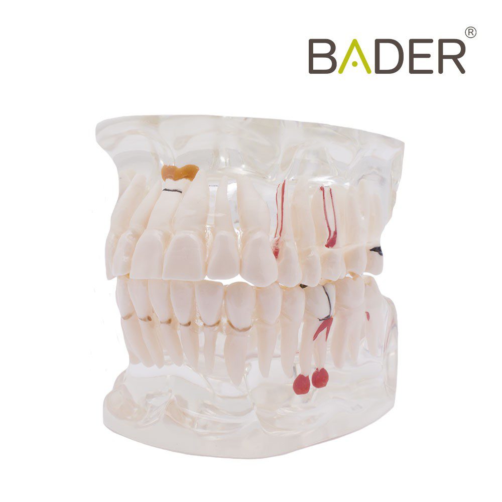 MODELO DENTAL TRANSPARENTE CARIES