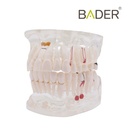MODELO DENTAL TRANSPARENTE CARIES