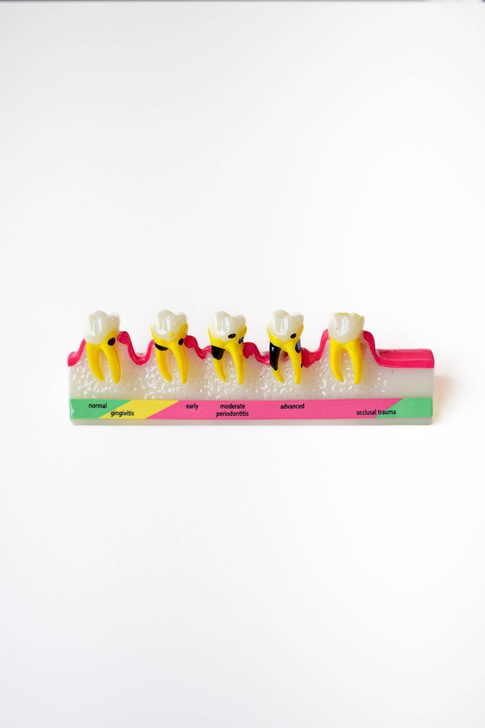 MODELO PROGRESIÓN DE ENFERMEDAD PERIODONTAL