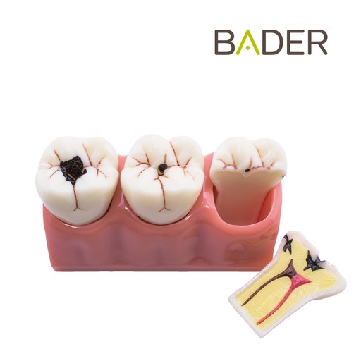 [0905101] MODELO DEMOSTRACIÓN DESMONTABLE CON CARIES