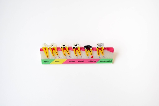 [0905139] MODELO PROGRESIÓN DE CARIES